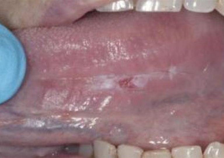 Detection Of Early Stage Oral Cancer Lesions A Survey Of California